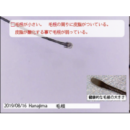 頭皮チェック